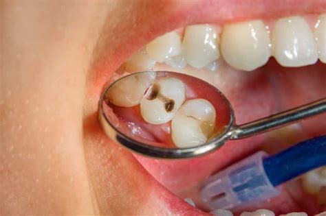 Dente desvitalizado infectado  Limpeza e branqueamento dos dentes: importância O dente é constituído por 3 camadas principais, sendo a polpa dentária (a parte mais mole presente no interior do dente) constituída, maioritariamente, por nervos e vasos sanguíneos